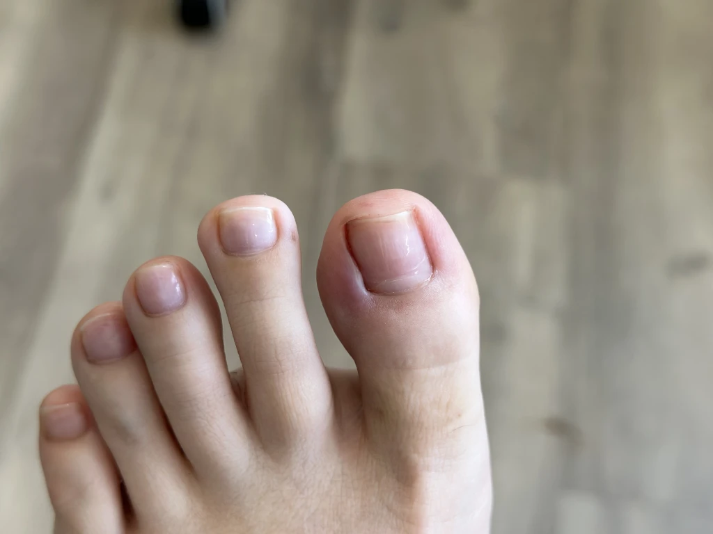 Close-up of the toes of a bare foot with mild redness along the skin fold beside the big toenail, the nail fold where paronychia develops.