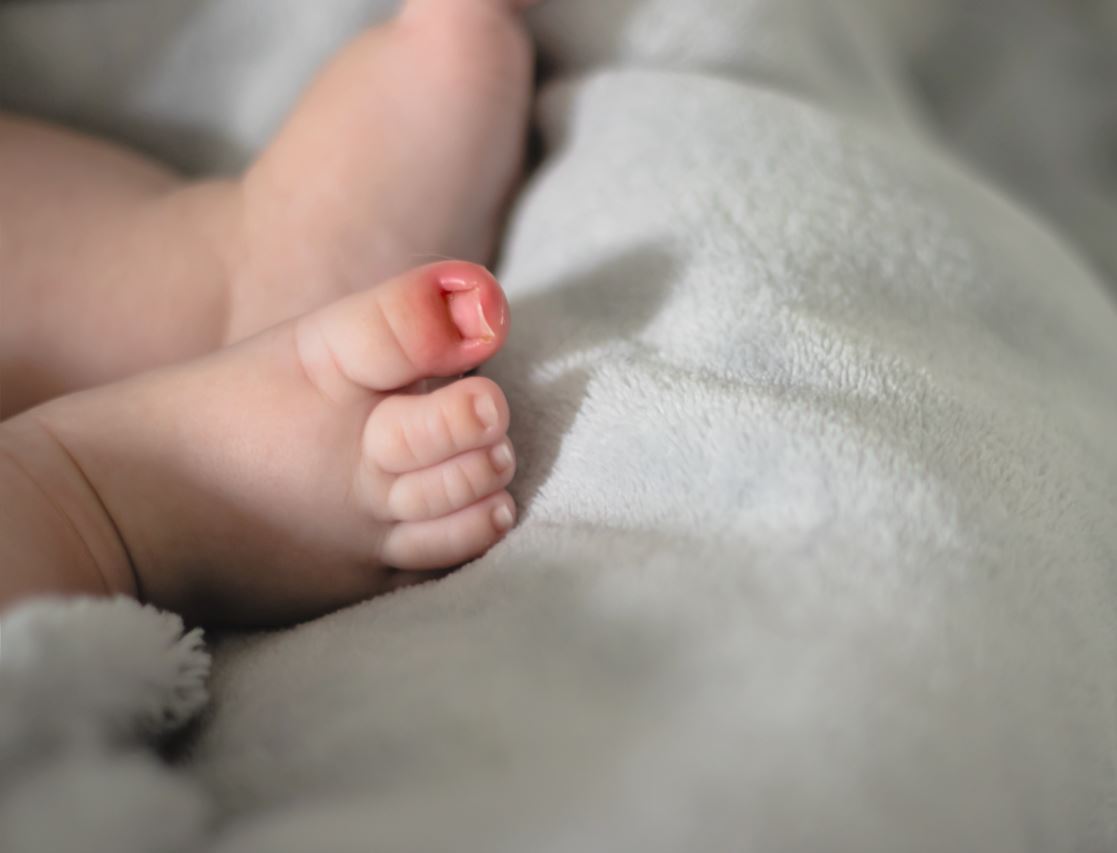 Ingrown toenail in children