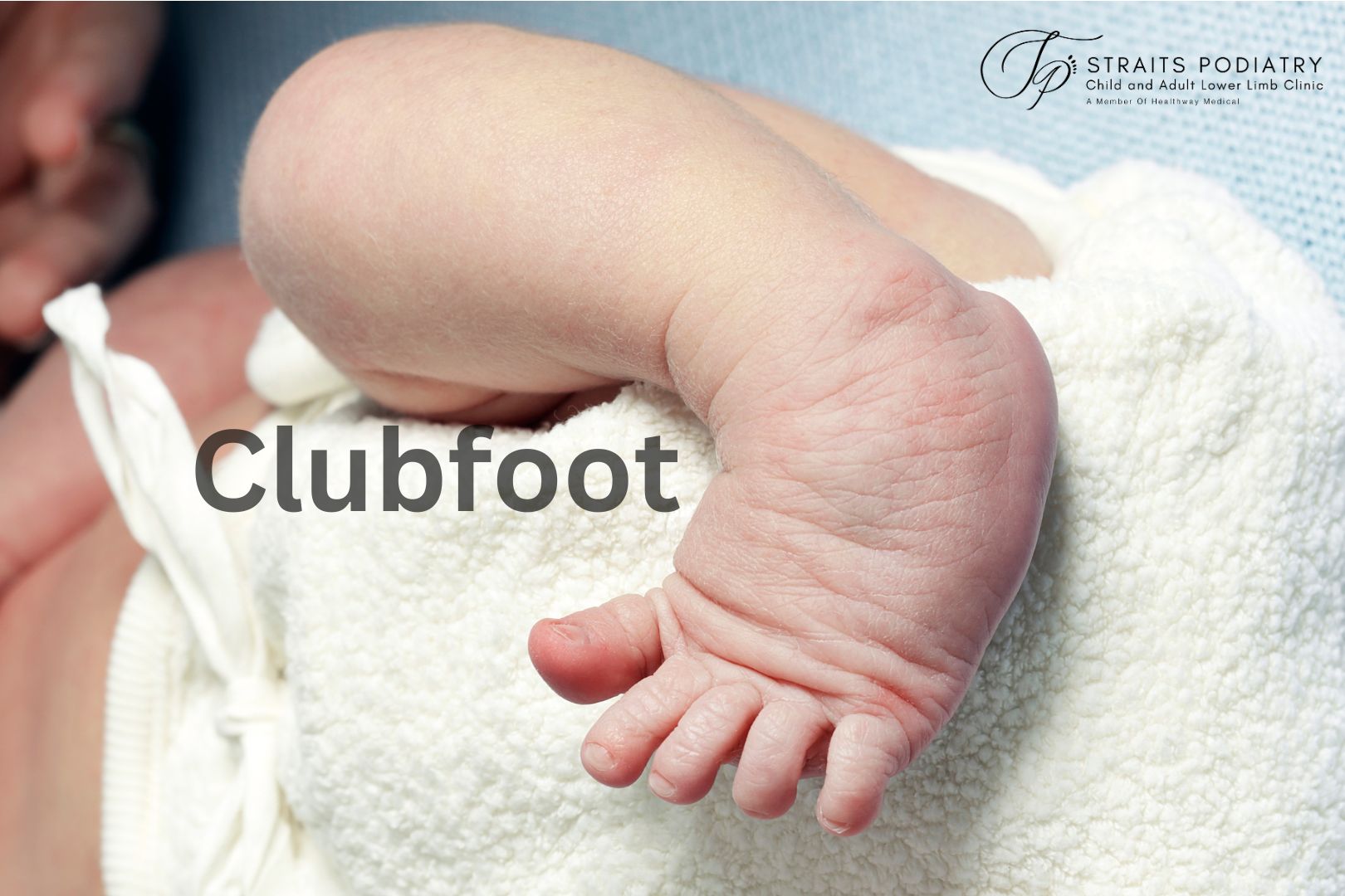 Clubfoot, a congenital foot deformity. Straits Podiatry