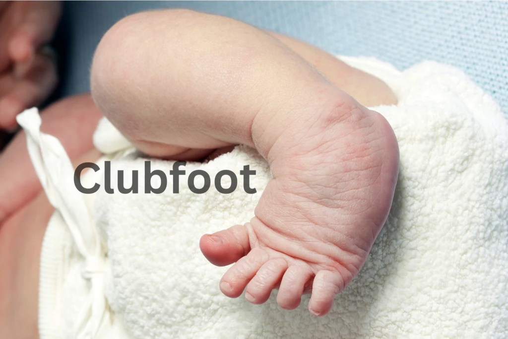 Close-up of a newborn's foot turned inward and downward against a white blanket, the classic appearance of clubfoot, captioned Clubfoot.