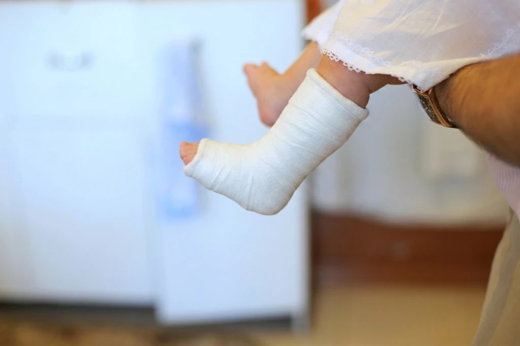 A baby's lower leg and foot in a white plaster cast, the casting used to correct clubfoot, held up by an adult with the other foot visible behind.