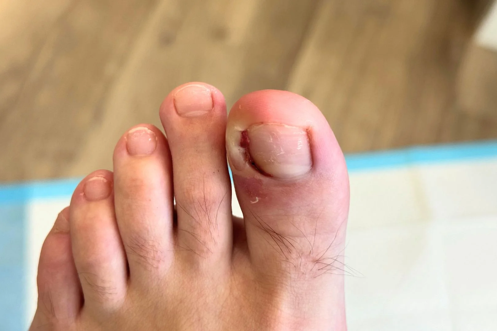 Treatment options for infected ingrown toenail