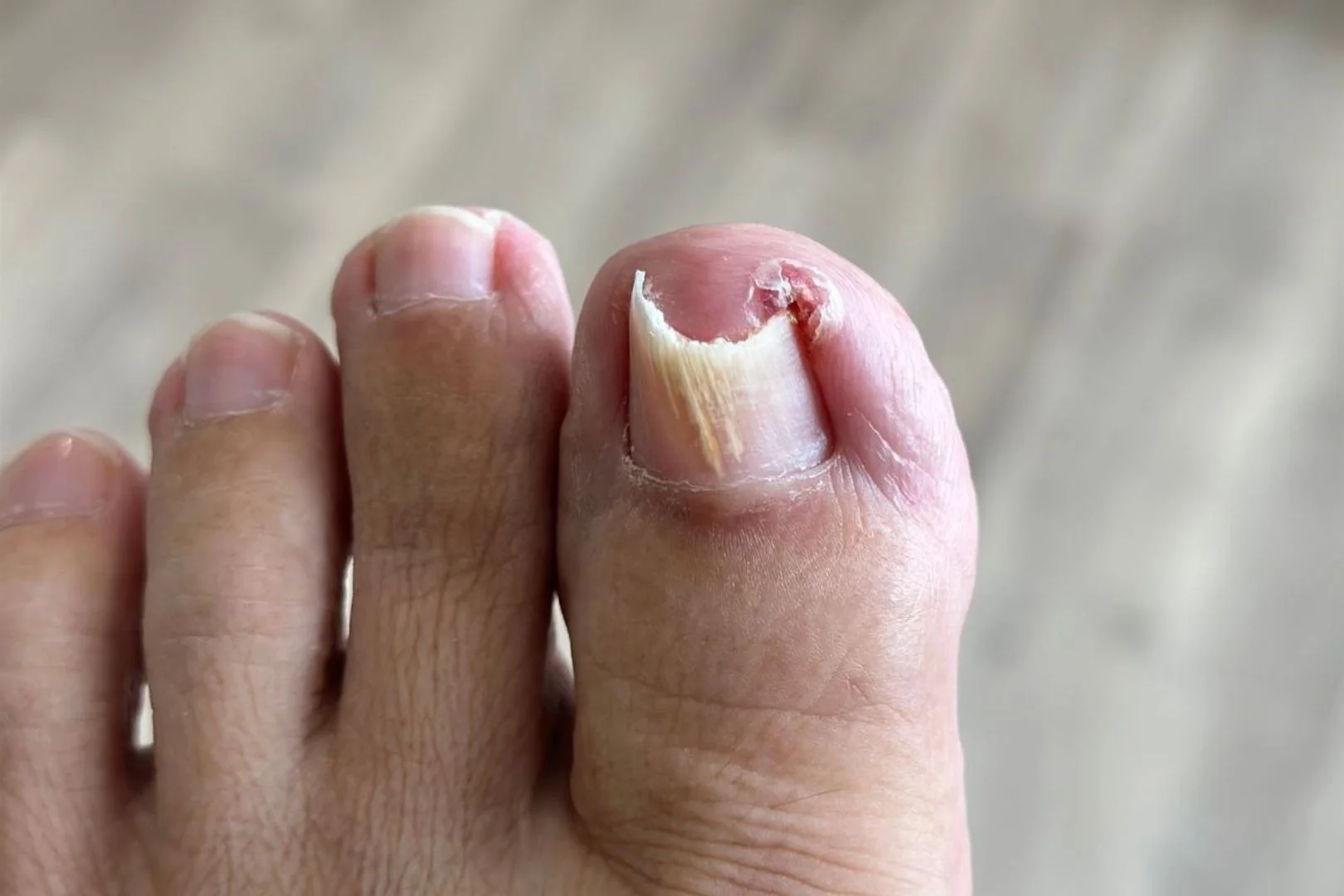 Causes of Ingrown Toenails