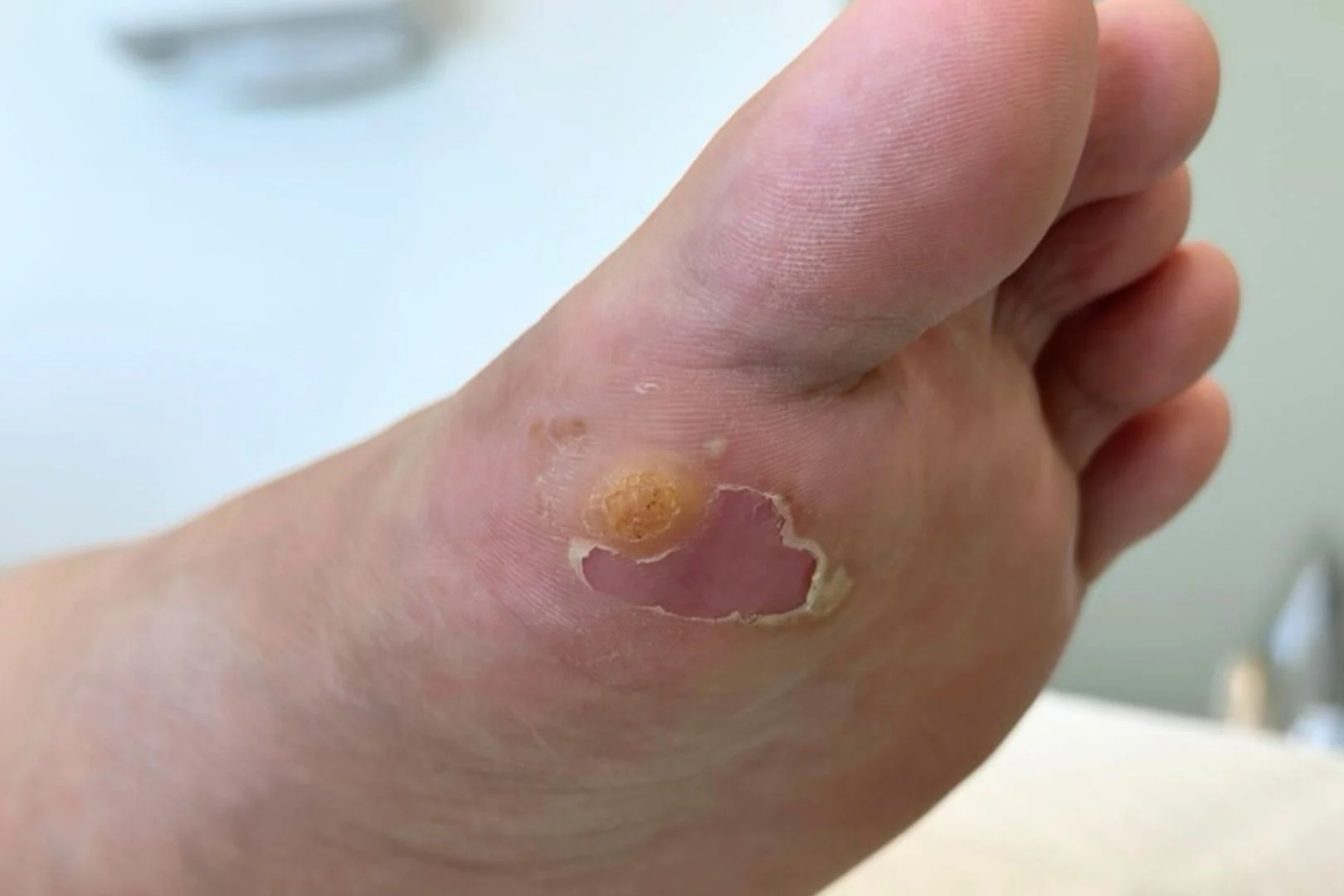 Foot wart treatment