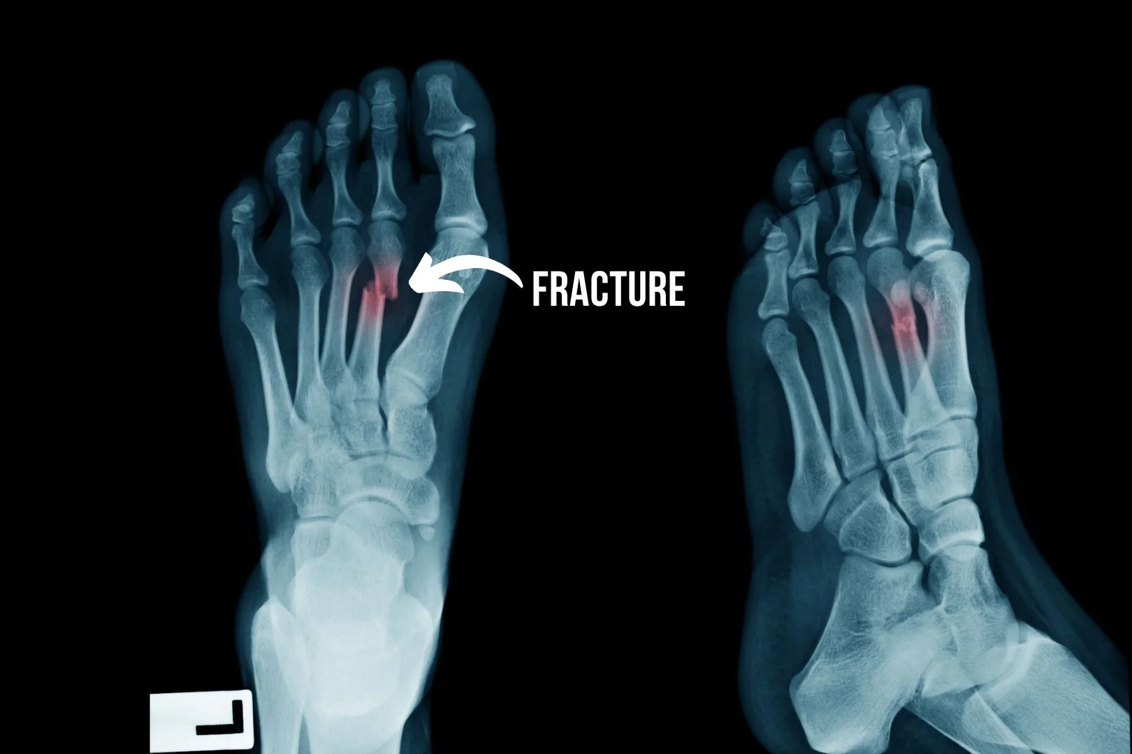 X-ray showing complete fracture of left second metatarsal bone