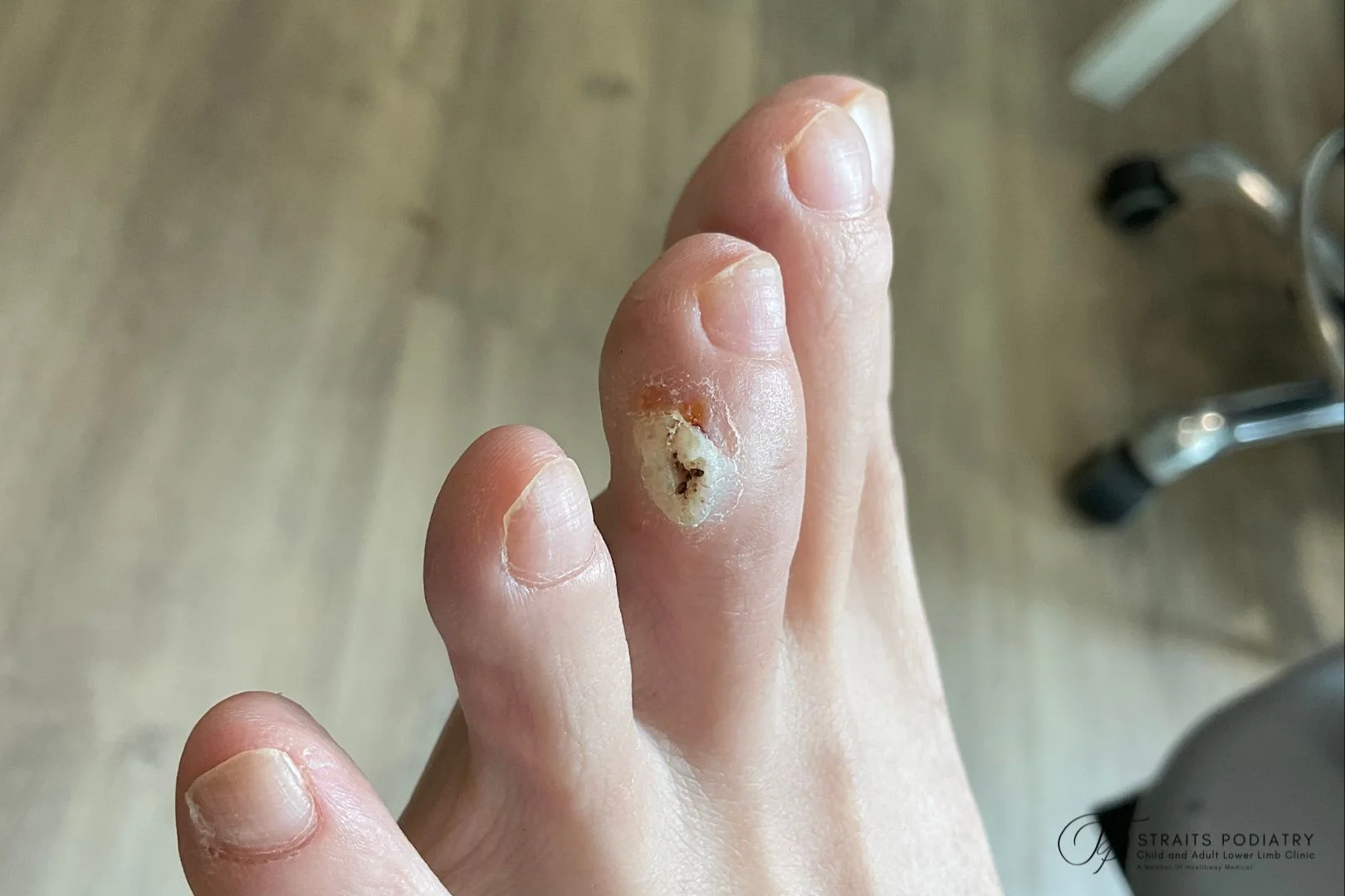 Wart treatment on toe