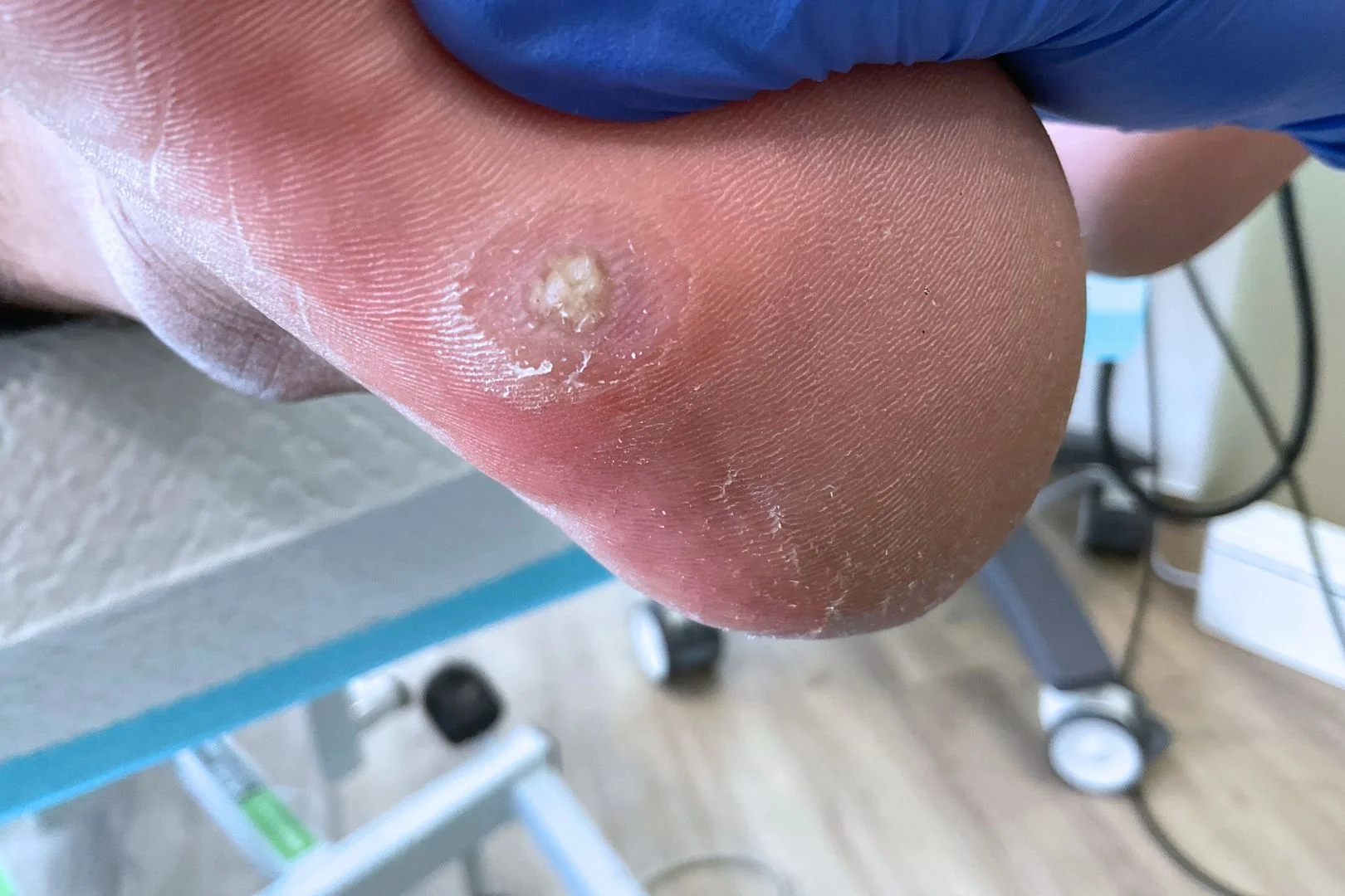 Plantar wart treatment on the heel