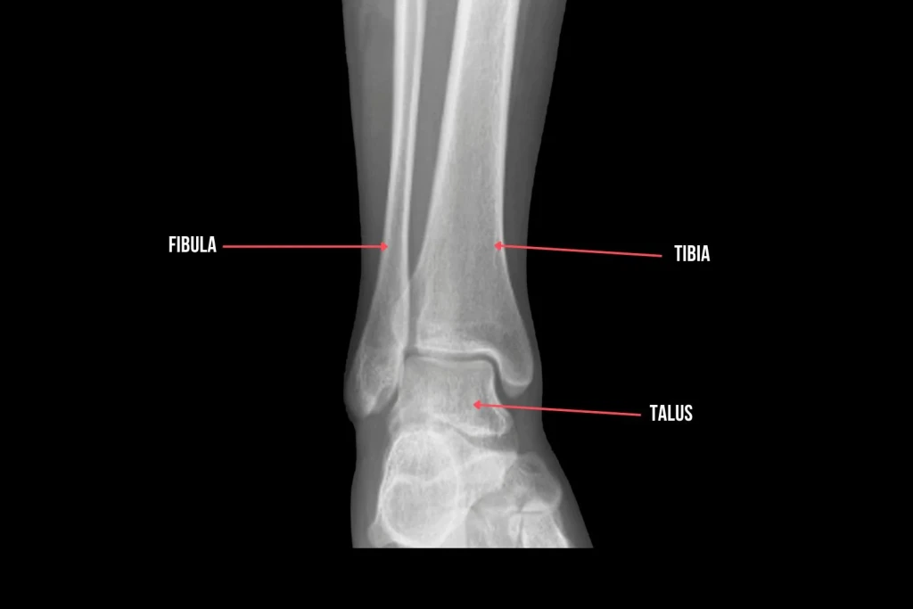 A labelled ankle X-ray with red arrows marking the fibula, tibia and talus, the three bones that make up basic ankle anatomy.