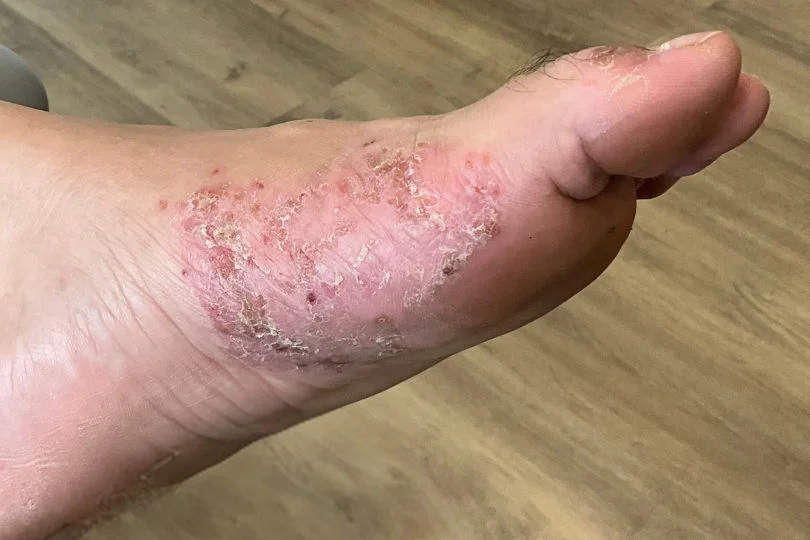 fungal skin infection (athlete's foot) of the left foot.