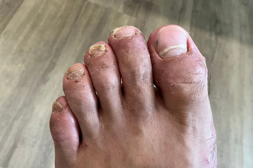 Fungal toenail and skin infection.