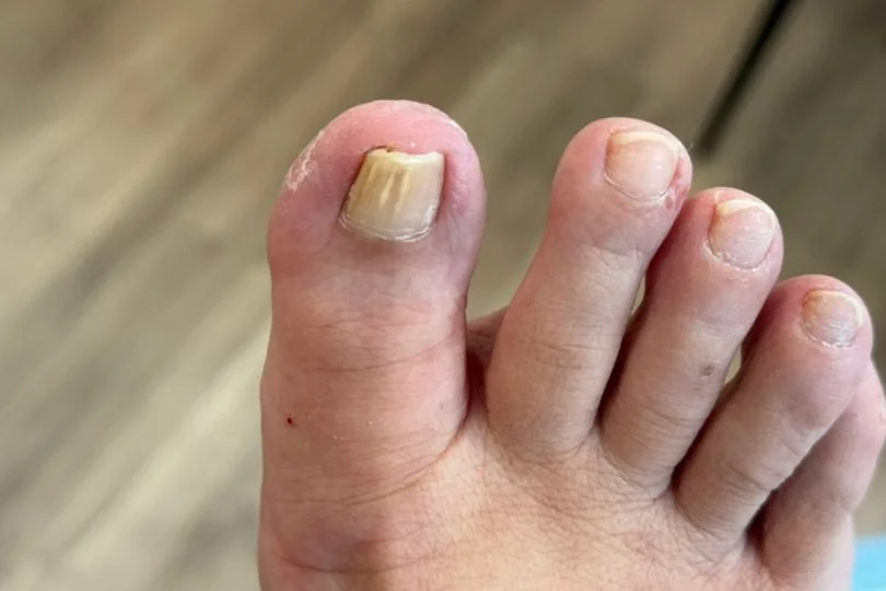 Fungal toenail infections.