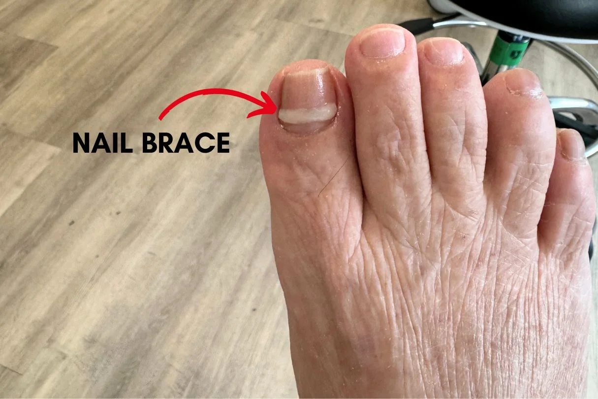 Nail bracing ingrown toenail treatment