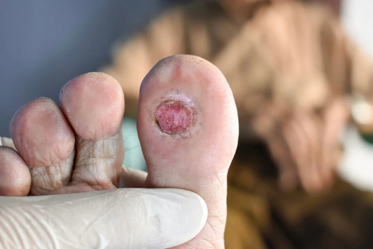 Diabetic Foot Ulcer