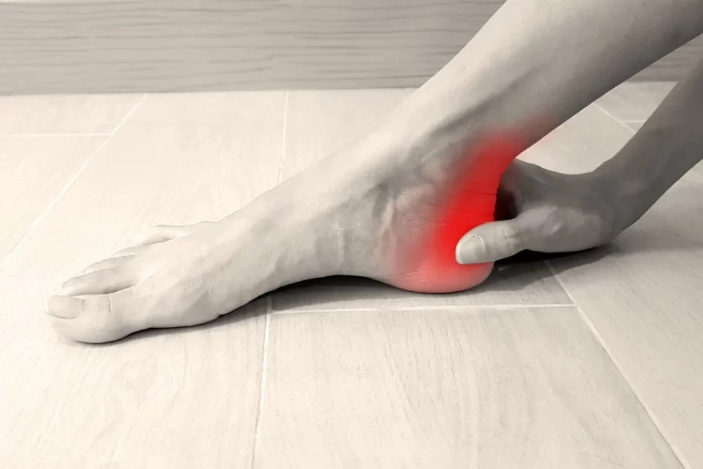 heel pain from retrocalcaneal bursitis