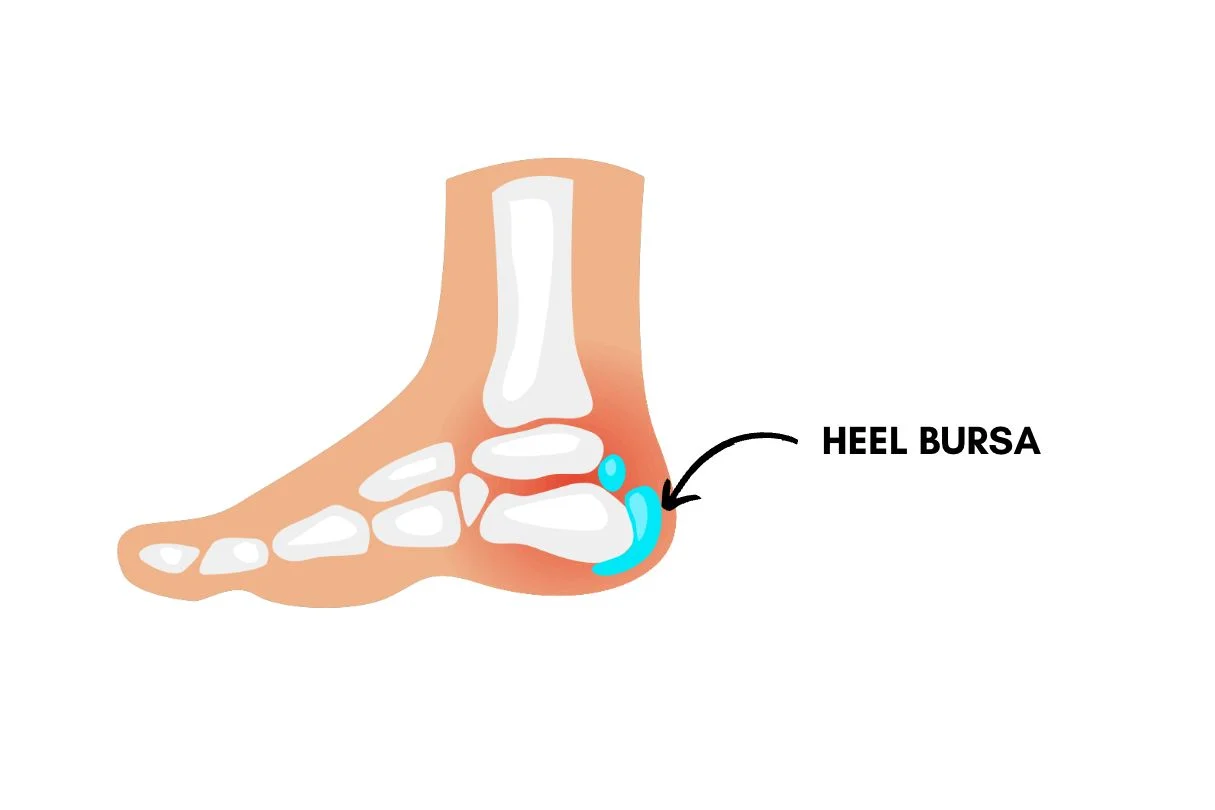 Retrocalcaneal bursitis (Heel bursitis)