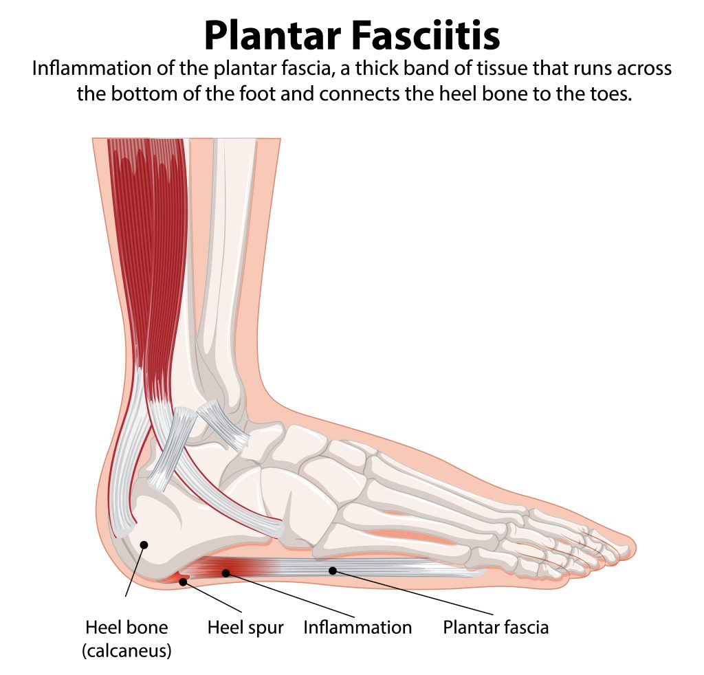 what is plantar fasciitis treatment