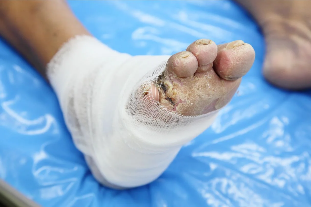 Diabetic foot complication, toe amputation.