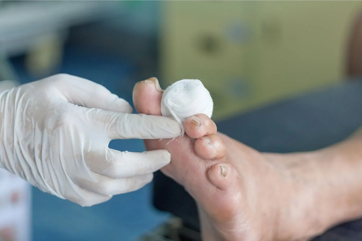 diabetic foot ulcer with wound dressing