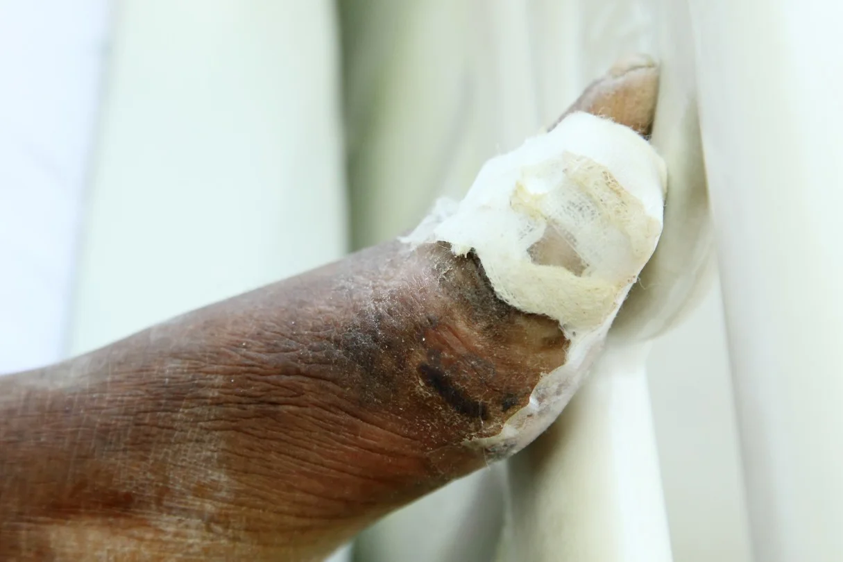 gangrene of the left big toe in patient with diabetes
