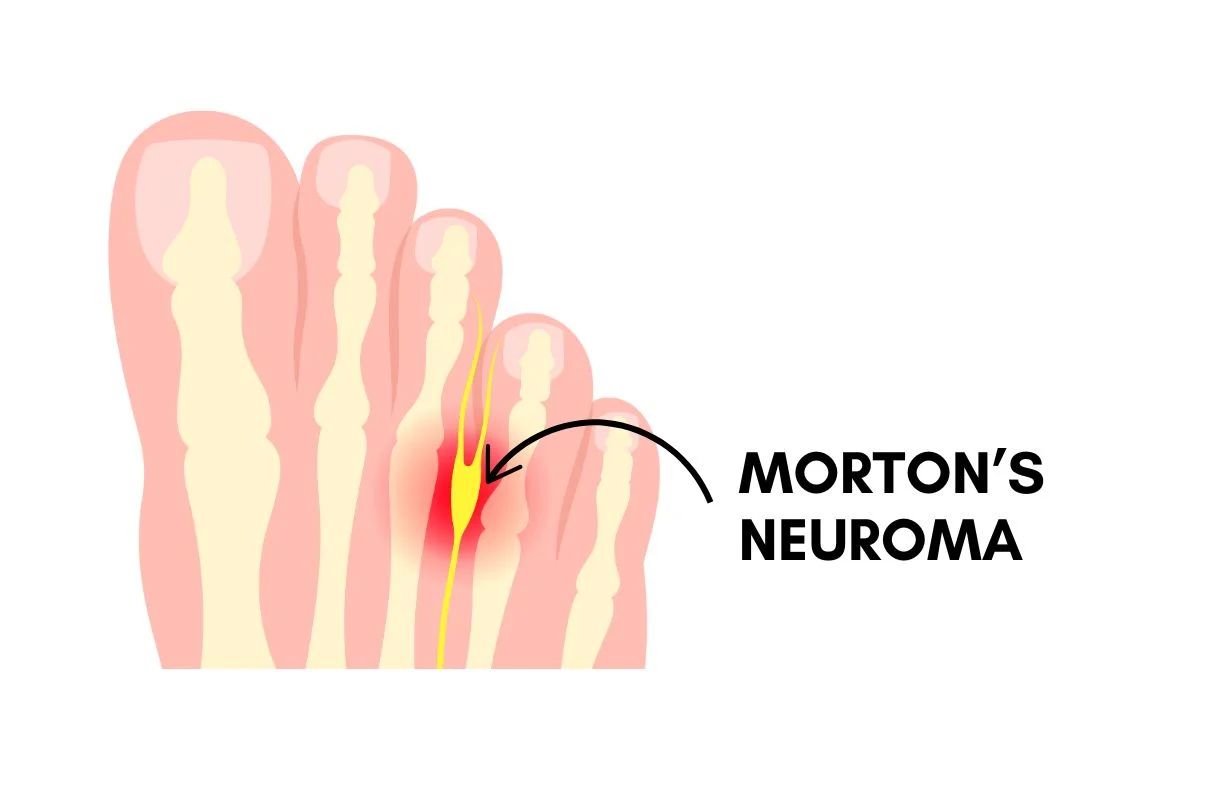 illustration showing the development of morton's neuroma