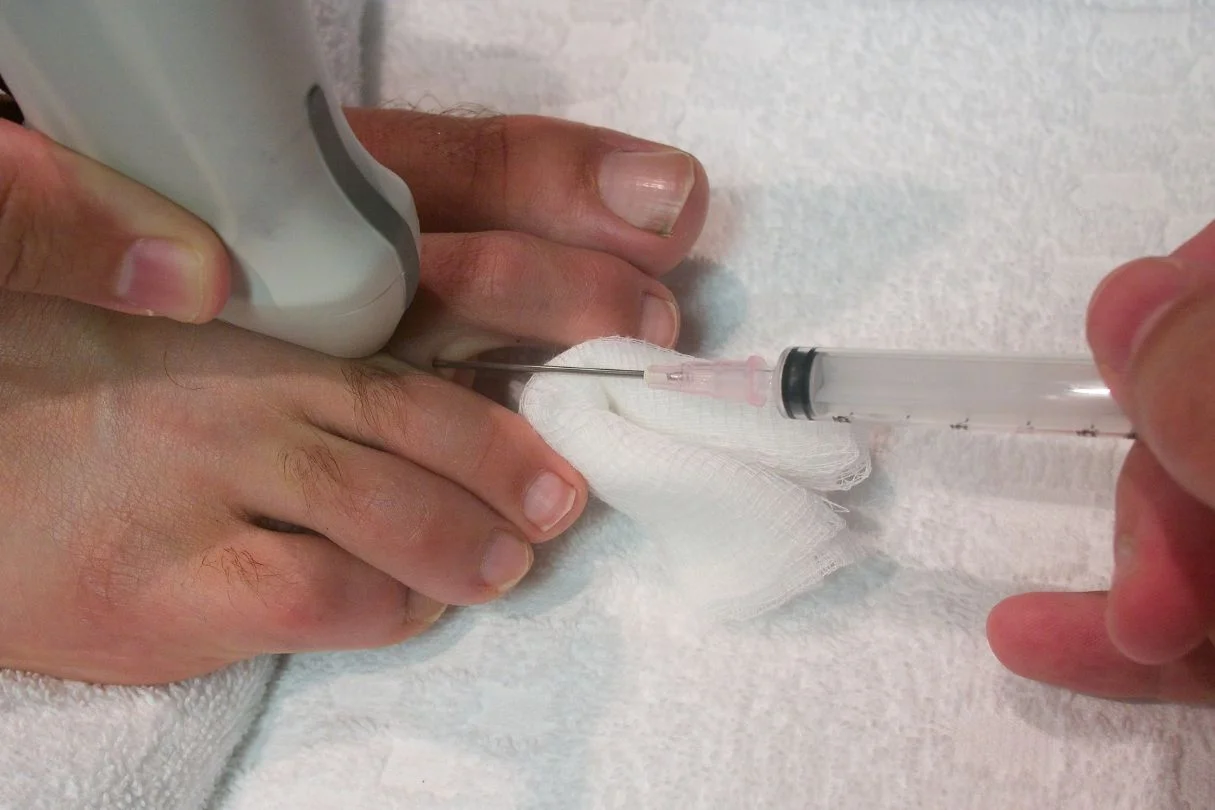 Morton's neuroma steroid injection