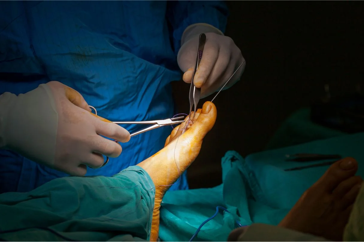 morton's neuroma surgery