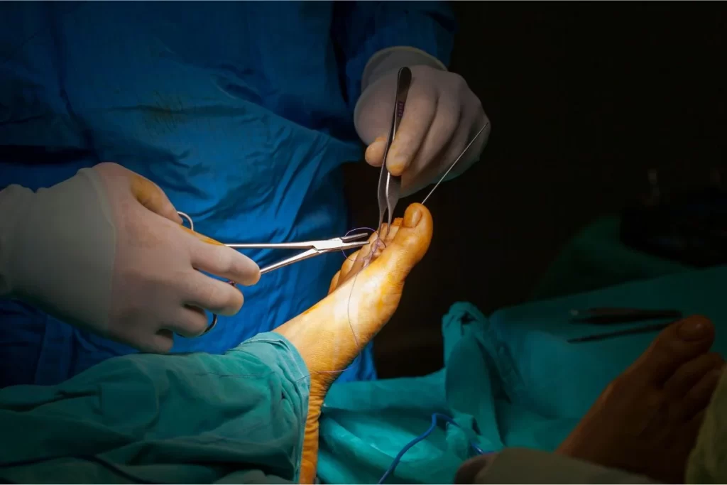 Morton's neuroma surgery