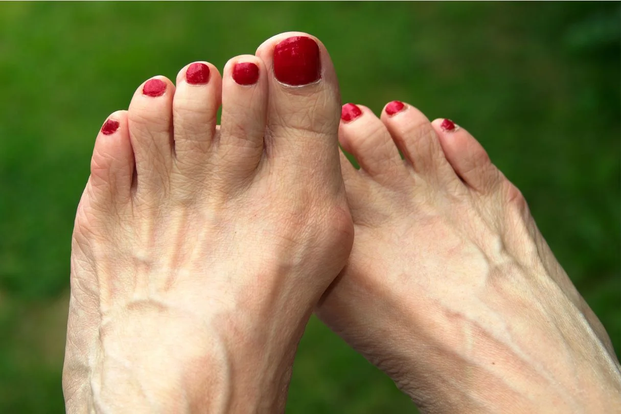 Bunion causing toe pain.