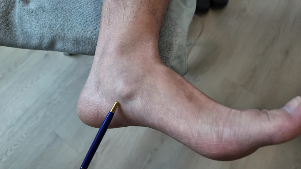 Illustration showing the affected area in Accessory Navicular Syndrome