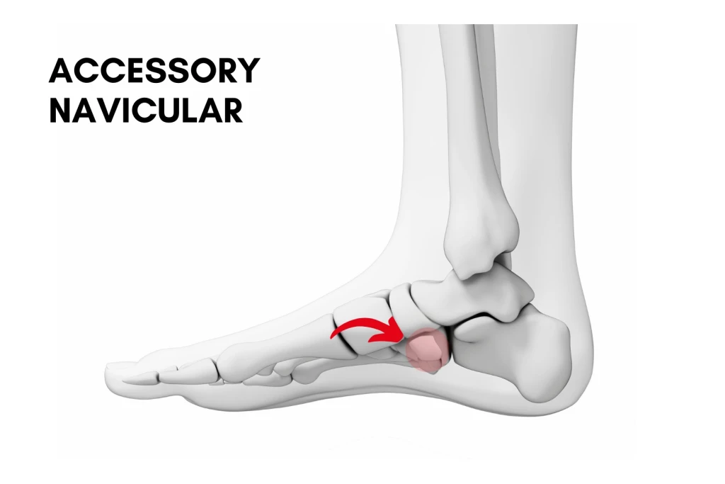 3D skeletal illustration of the inner side of the foot showing an accessory navicular, an extra bone highlighted in red beside the navicular bone, with an arrow pointing to it.