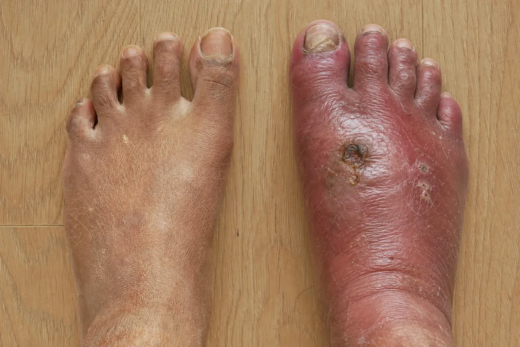 Two bare feet side by side, the right one red, swollen, and shiny with a dark crusted open wound across the midfoot, showing how a diabetic foot infection can present.