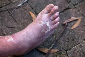 Diabetic foot infection