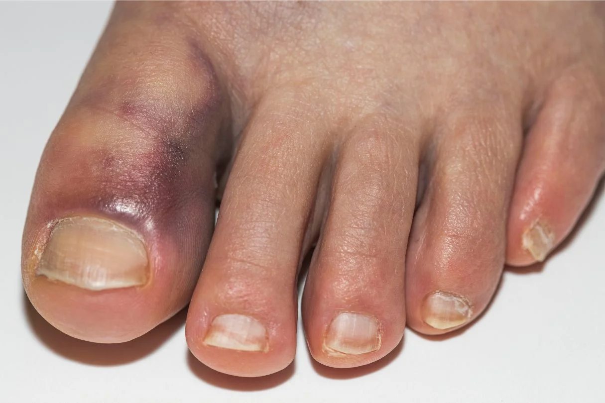 Signs and symptoms of turf toe