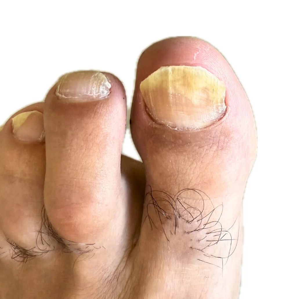 patient of Straits Podiatry with fungal nail infection of the big toe