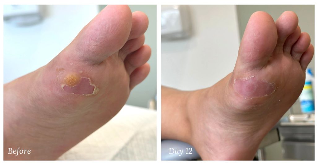 patients foot after wart removal treatment