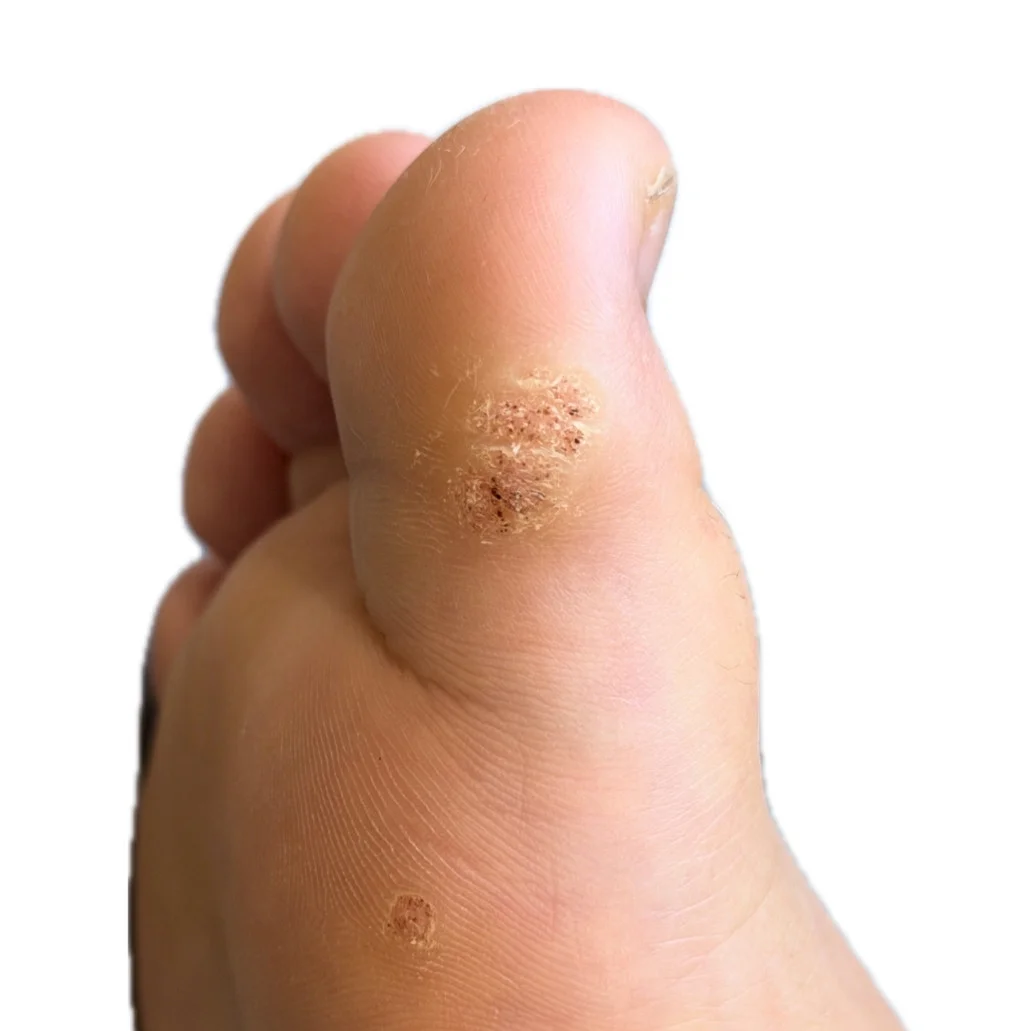 Patient of Straits Podiatry with plantar warts of the big toe