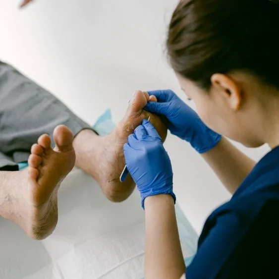 Callus and corn debridement by podiatrist in Singapore