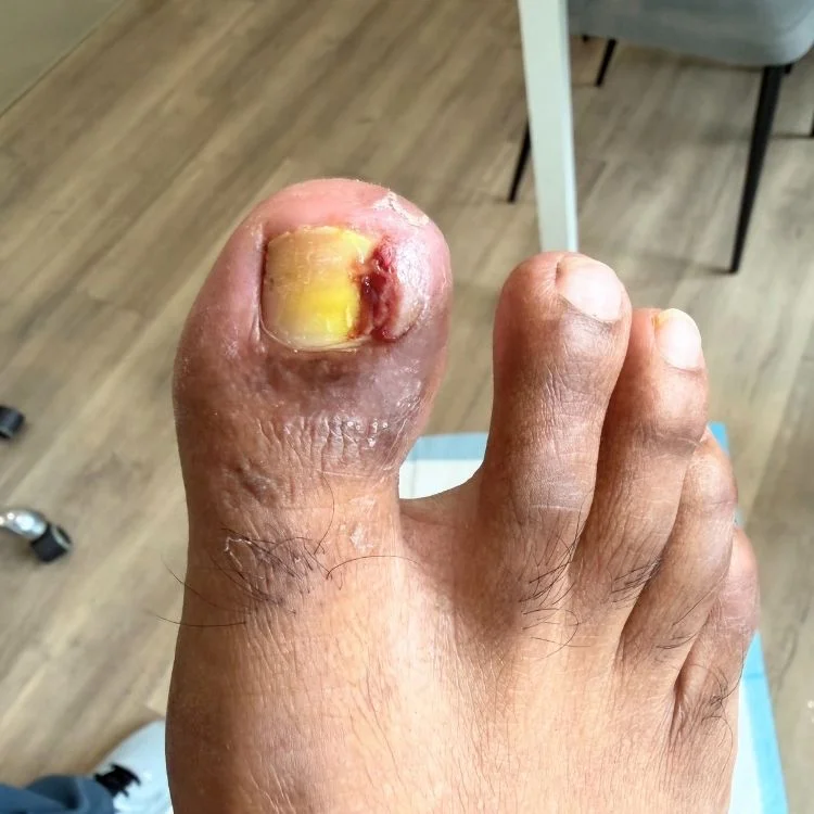 infected ingrown toenail of the right big toe
