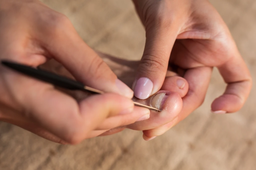 A person using a thin tool to dig at the corner of their own big toenail, an example of unsafe do-it-yourself ingrown toenail treatment at home