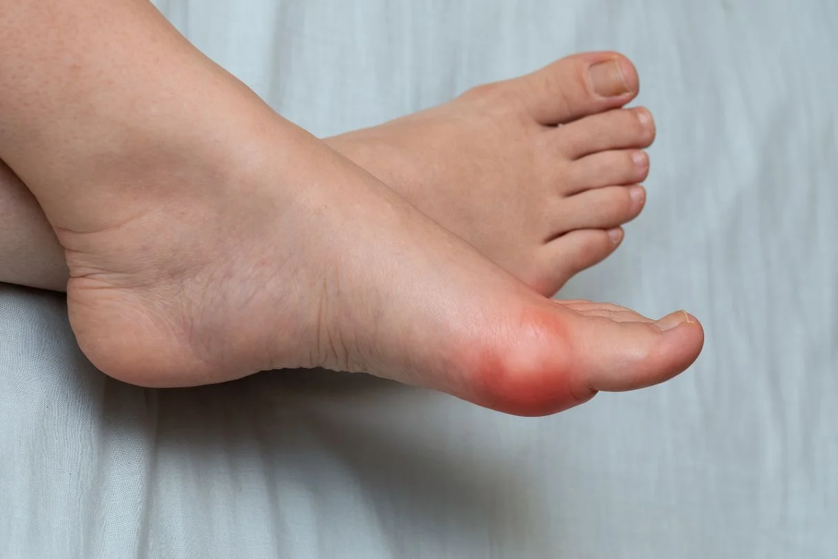 大脚趾疼痛肿胀，可能是痛风或拇外翻所致