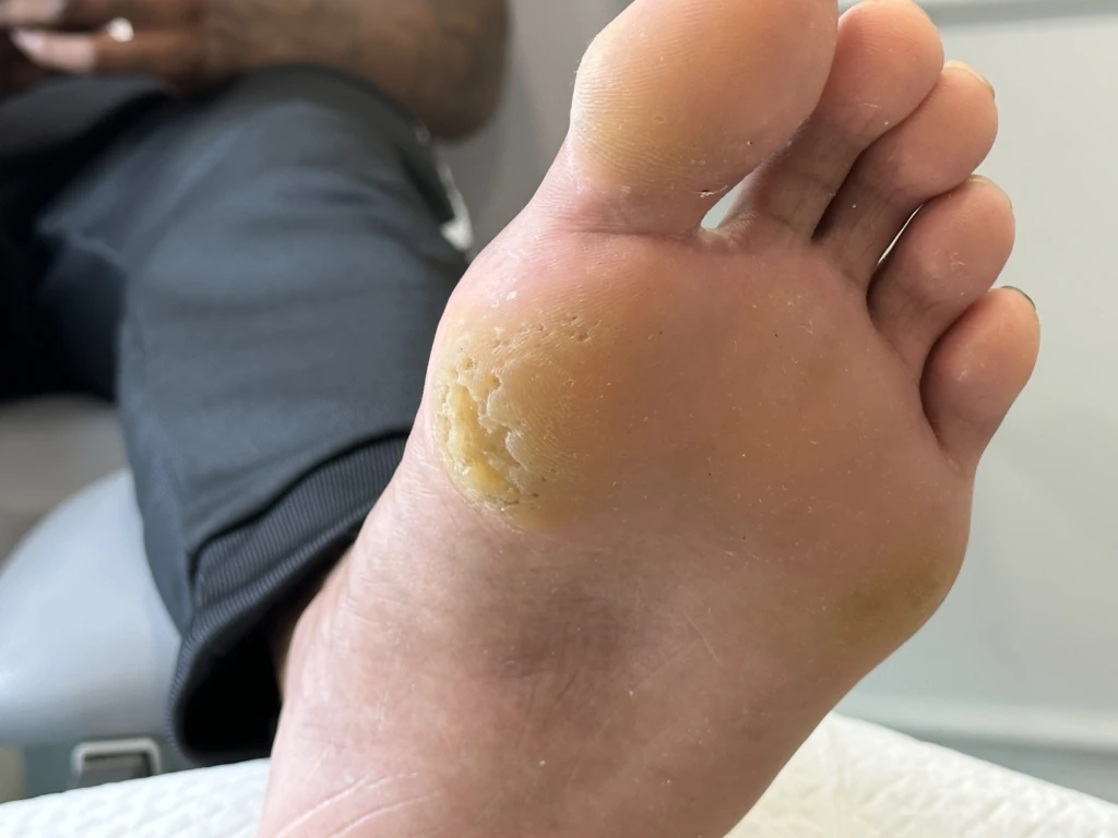 足科医师评估足部与下肢,以找出引发足部老茧的因素
