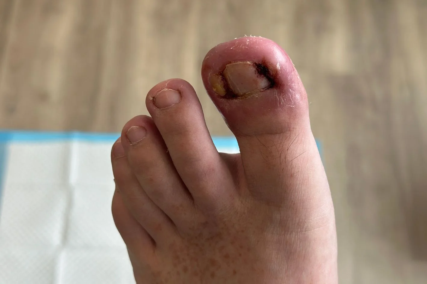 Patient with left big toe recurring infected ingrown toenail