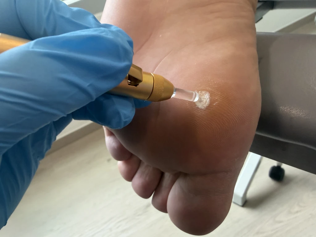 戴着手套的手持一支带透明尖端的金色冷冻治疗笔,抵在诊所内患者脚掌上一处小的角化疣状病灶上。