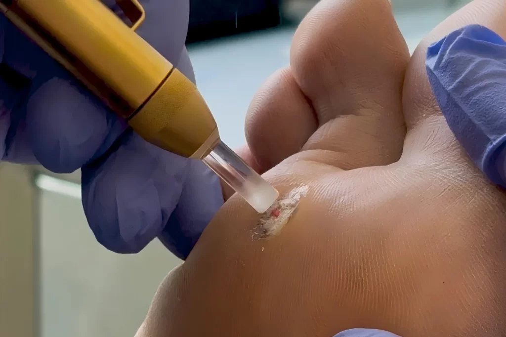 Podiatrist in Singapore performing wart cryotherapy on patient's foot