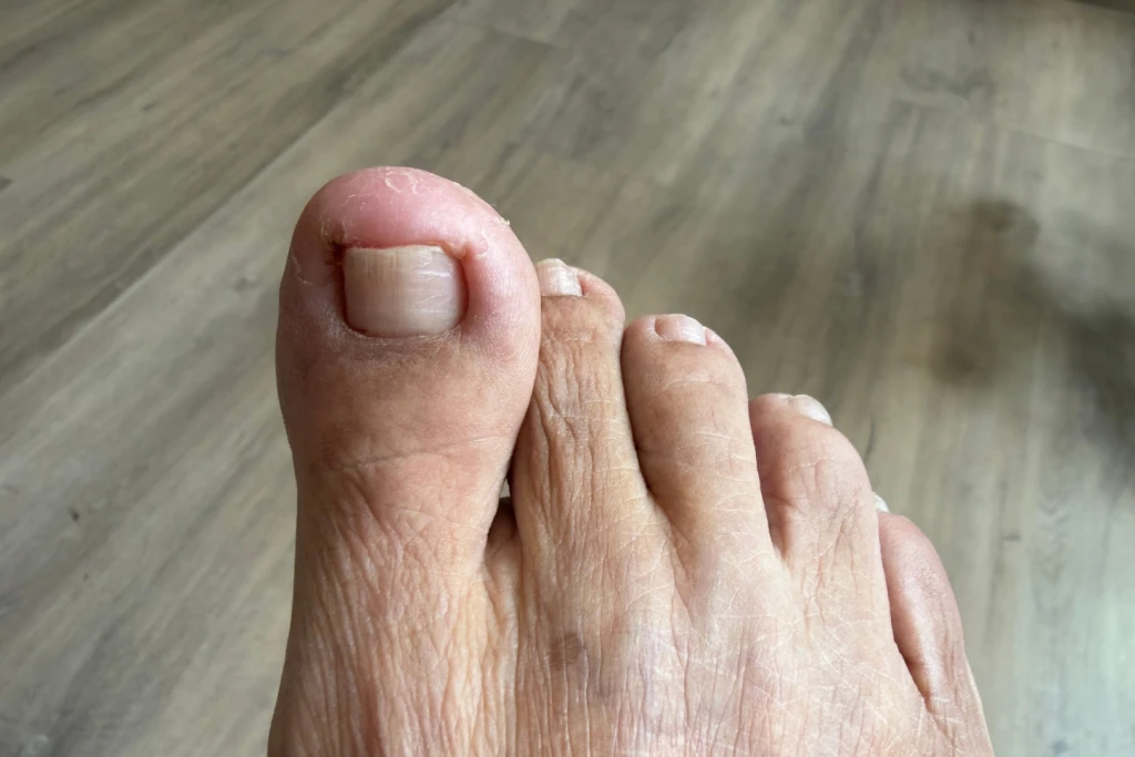 Close-up of a bare foot showing a big toenail whose edge presses into reddened, flaky skin at the side of the toe, the recurring ingrown toenail pattern.