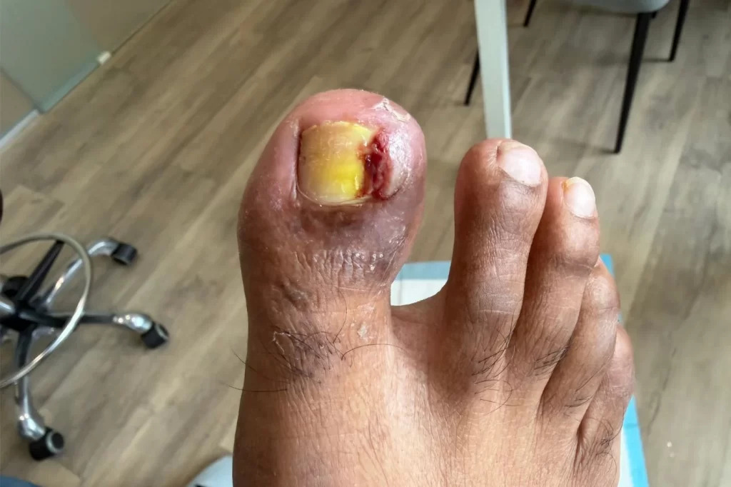 chronic infection of the right big toe ingrown toenail with hypergranulation tissue