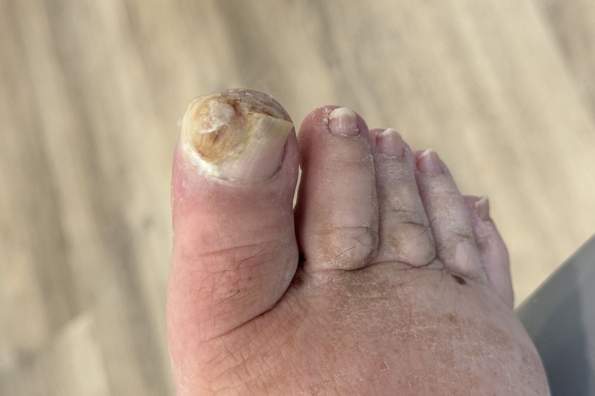 Chronic paronychia of the right big toe
