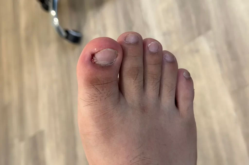 infected right big toe ingrown toenail with pus discharge