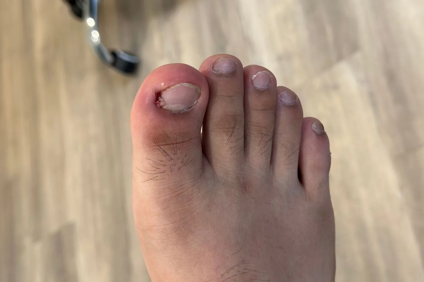 infected right big toe ingrown toenail with pus discharge