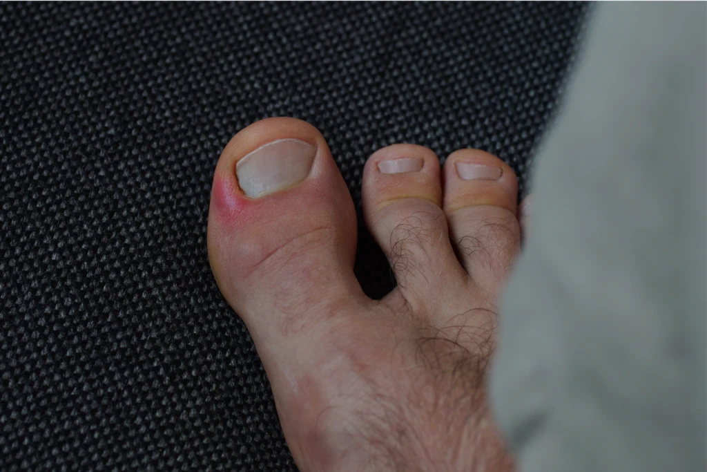 Podiatrist assessing the foot and lower limb to identify factors contributing to Paronychia